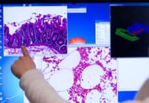 Weniger Fälle von Darmkrebs in Rheinland Pfalz: Diagnose trotzdem noch häufig