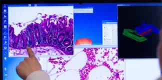 Weniger Fälle von Darmkrebs in Rheinland Pfalz: Diagnose trotzdem noch häufig